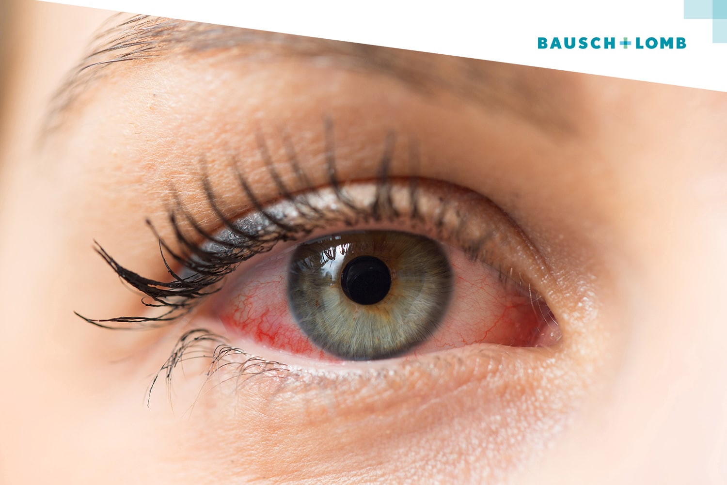 Soczewki dla alergika. Co trzeba wiedzieć?